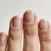 Brittle nails