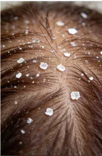 Dry flaky scalp